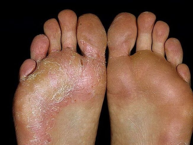 fungus-between-toes-treatment-micinorm